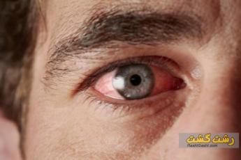 آفتاب سوختگی چشم