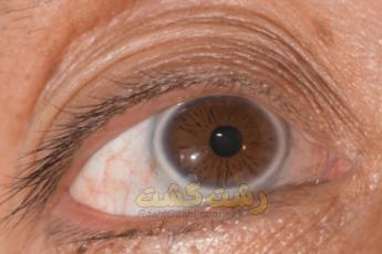 قوس قرنیه