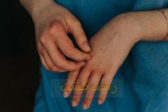 علل خارش انگشت