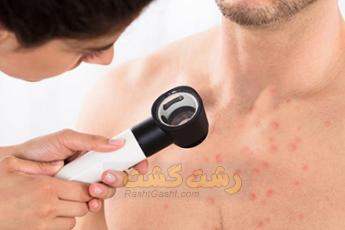 جوش های رو سینه