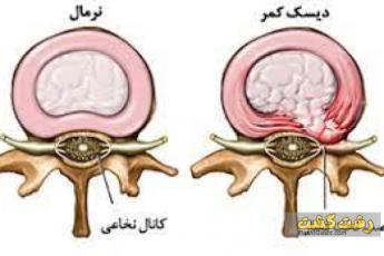 دیسک کمر در بارداری